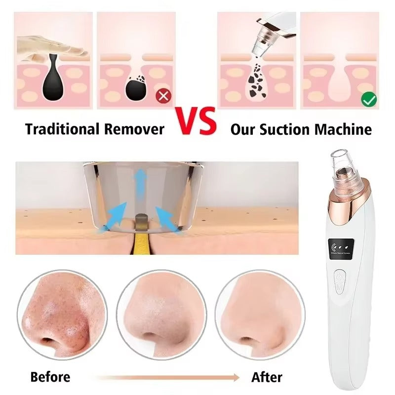 Electric Blackhead Remover – Deep Pore Vacuum Cleaner